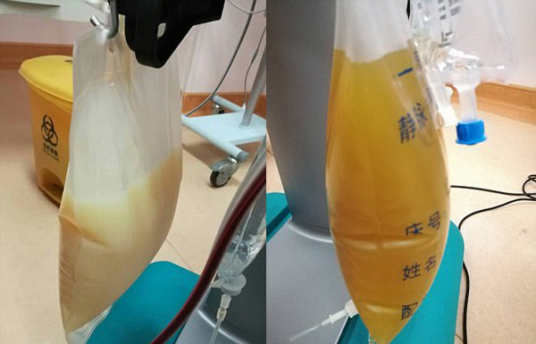 中山男子腹痛紧急送医抢救，检出“牛奶血”！