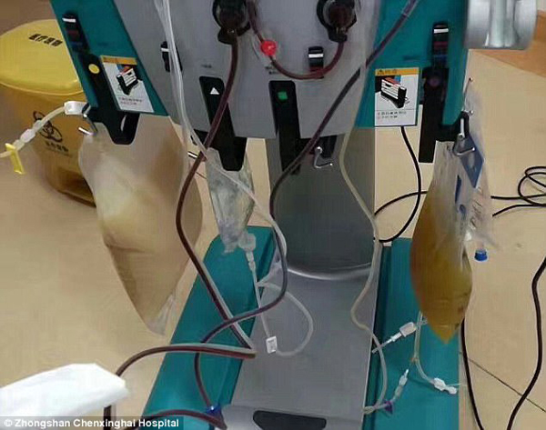 中山男子腹痛紧急送医抢救，检出“牛奶血”！