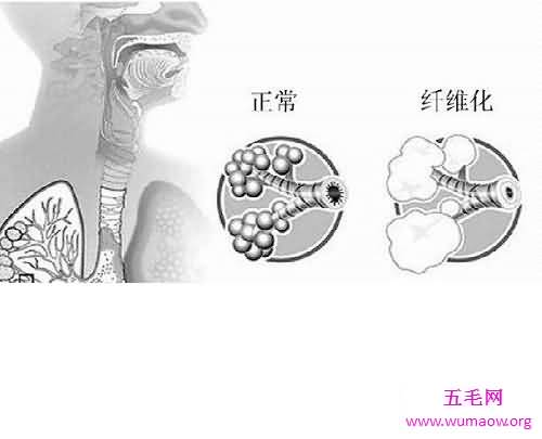 肺纤维化——它会让你的生活不再有色彩