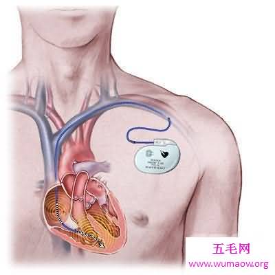 人类史上十大最意外的发明，伟哥原来是心脏药