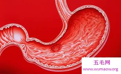 胃溃疡最常见三大症状，预防胃溃疡的方法