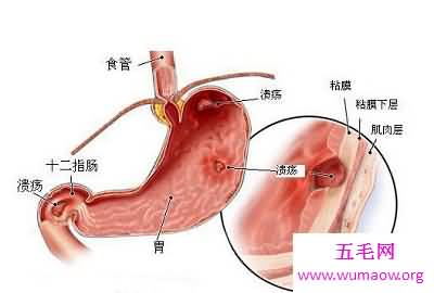 胃溃疡最常见三大症状，预防胃溃疡的方法