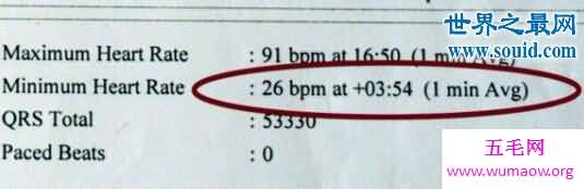 世界上心跳最慢的人，81岁英国老人(每分钟26下)