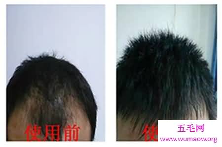 现在白发转黑发的方法很受欢迎，希望能解决你的困扰！