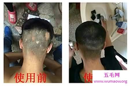 现在白发转黑发的方法很受欢迎，希望能解决你的困扰！