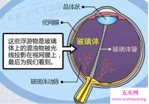 困扰人的飞蚊症怎么治疗才能达到最好的效果