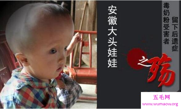 安徽阜阳大头娃娃事件曝光，食用劣质奶粉所导致