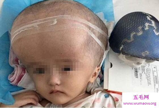 安徽阜阳大头娃娃事件曝光，食用劣质奶粉所导致