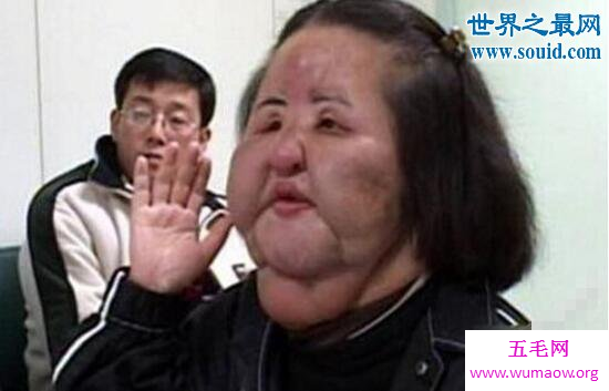 整容狂魔韩苗可，往脸上注射食用油导致毁容