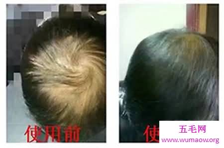 现在白发转黑发的方法很受欢迎，希望能解决你的困扰！