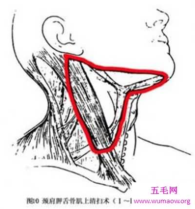 颈部淋巴结分区介绍 淋巴结肿大的原因介绍