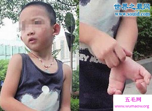 八岁男孩天生“螃蟹手”，惨遭家人三次抛弃