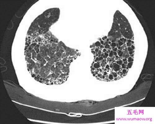 肺部纤维化病因原由介绍 症状以及治疗方法介绍