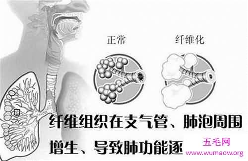 肺部纤维化病因原由介绍 症状以及治疗方法介绍