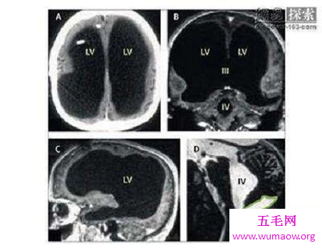 一个人没有脑子居然可以活？揭秘无脑人叶先国灵异事件