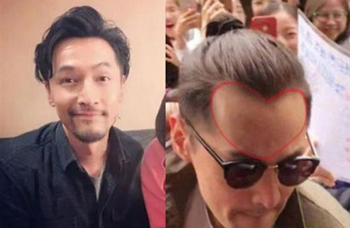 为什么男性秃头都秃成一个样？心疼男神们的发际线