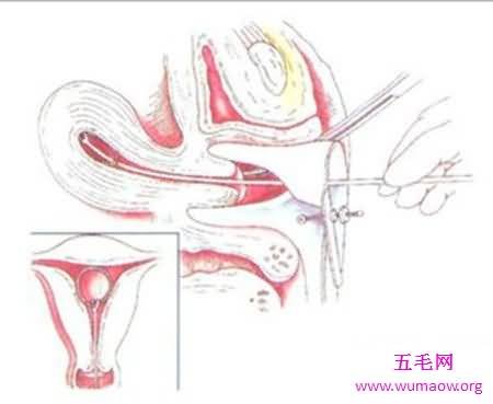 节育环图片到底是什么样子 就仅仅是一个环吗