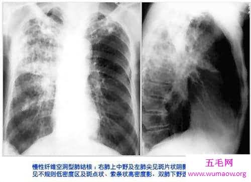 肺部纤维化病因原由介绍 症状以及治疗方法介绍