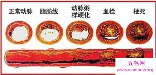 软化血管的食物及功效 想要寿命长必须先预防