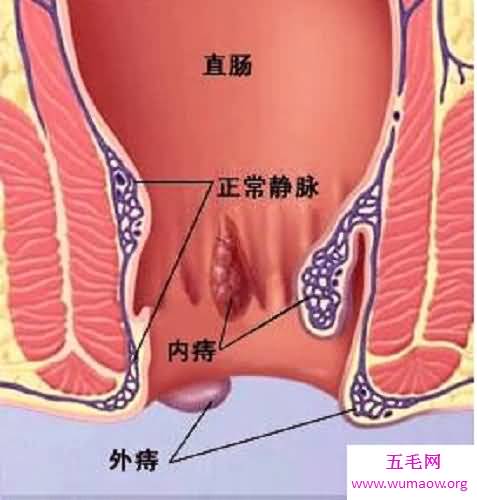 得了内痔，不吃药，自己会好吗？内痔的症状，该如何防止治疗内痔