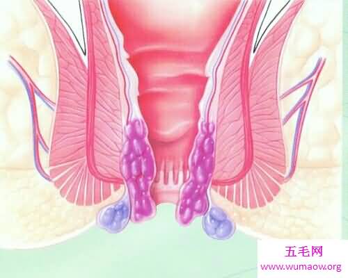 痔疮是一种非常痛苦的疾病 痔疮的症状是什么呢