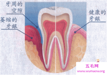 牙龈炎图片 快进来对比一下你有没有牙龈炎