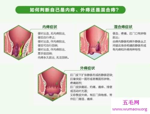 得了内痔，不吃药，自己会好吗？内痔的症状，该如何防止治疗内痔