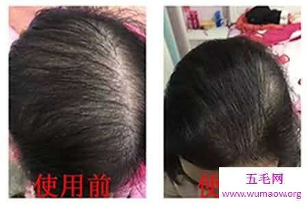 现在白发转黑发的方法很受欢迎，希望能解决你的困扰！