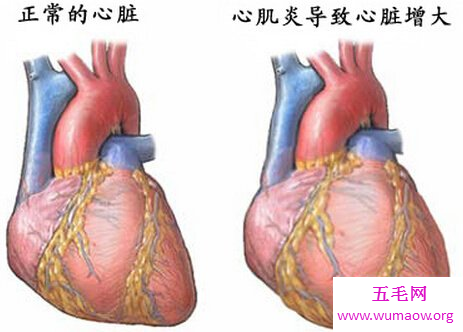 懂得爱护自己，关注身体健康，从了解心肌炎开始！