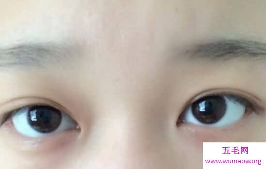 死鱼眼是什么样子的，现实中是由于大脑损伤造成的