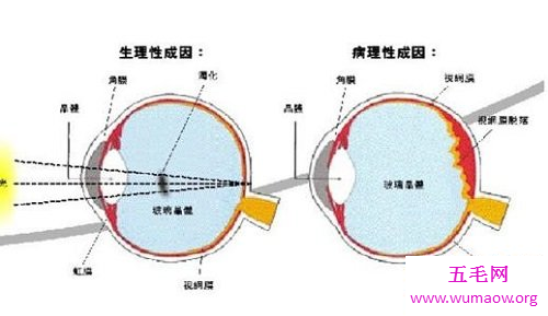 困扰人的飞蚊症怎么治疗才能达到最好的效果