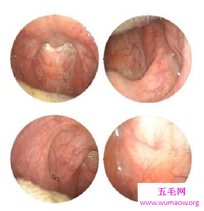 有哪些慢性咽喉炎最佳治疗方法可以尝试