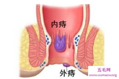 得了内痔，不吃药，自己会好吗？内痔的症状，该如何防止治疗内痔