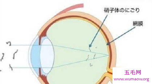 困扰人的飞蚊症怎么治疗才能达到最好的效果