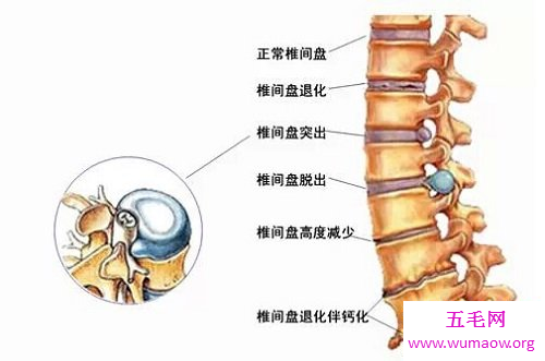 有了腰间盘突出的治疗方法，再也不用因疼痛而烦恼了