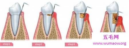 牙龈炎图片 快进来对比一下你有没有牙龈炎