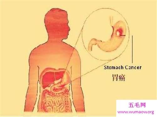 胃癌的早期症状是什么 怎样治疗胃癌有效果