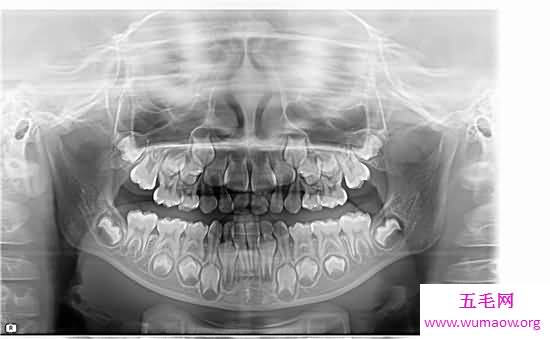 人有多少颗牙齿 8种牙齿不拔出影响身体疾病
