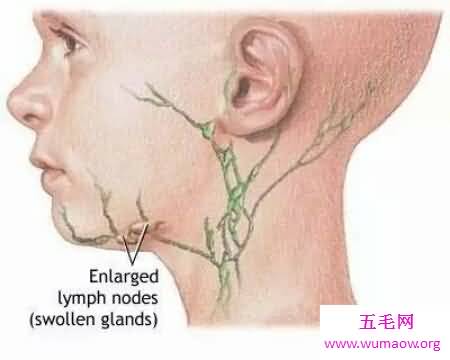 肠系膜淋巴结炎的了会很严重吗 怎么治疗