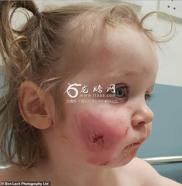 Little Willow-Ivy Doherty was left with 15 bite marks all over her face and body after being bitten by other children at the Little Bees soft play centre in Seacroft Leeds