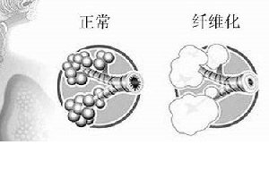 肺纤维化——它会让你的生活不再有色彩