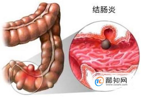 慢性结肠炎的症状是什么