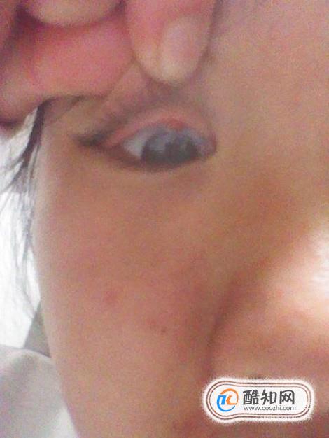 怎么办眼睫毛进眼睛里出不来了