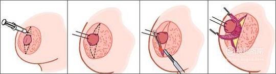 做乳房再造失败修复手术麻醉方式是什么？