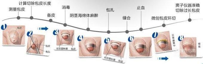 做背侧切口法治疗包茎手术麻醉方式是什么？