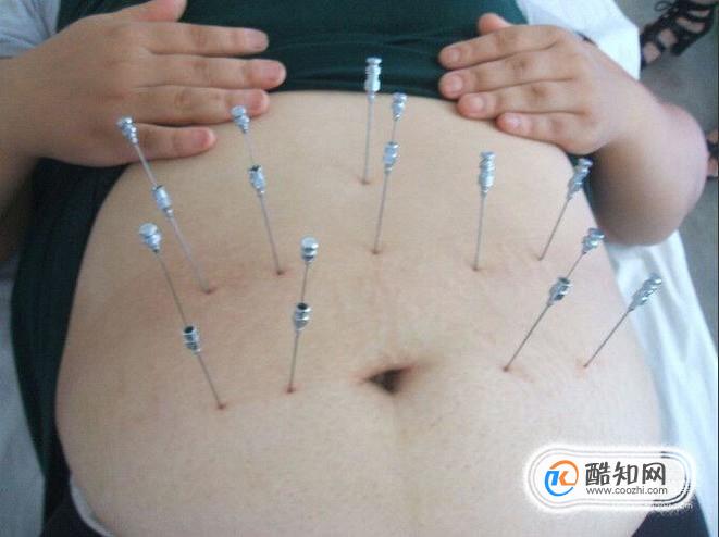 埋线减肥的优缺点