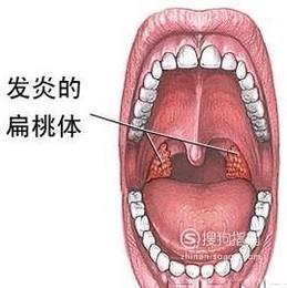 扁桃体炎怎么治疗