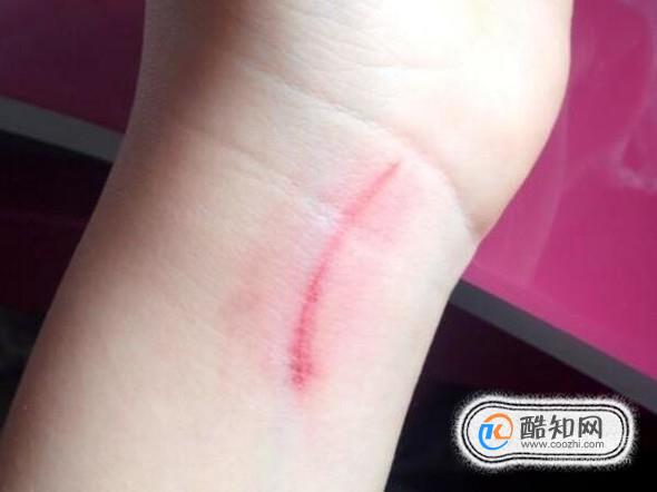加速伤口愈合的小妙招