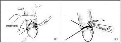 背侧切口法治疗包茎手术效果好不好？