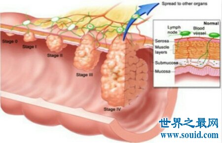 肠系膜淋巴结炎的了会很严重吗 怎么治疗